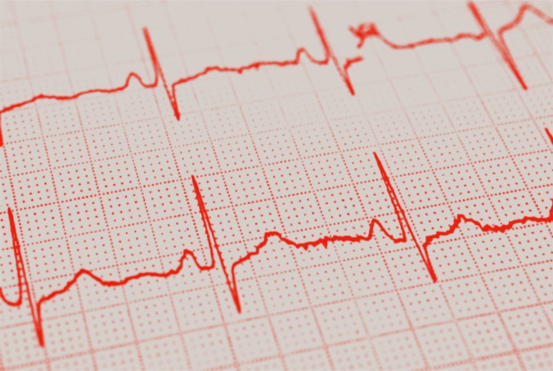 Electrocardiogram